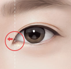 눈매 개선을 위한 앞윗트임 수술, 어떤 변화가 있을까? 관련 이미지 3