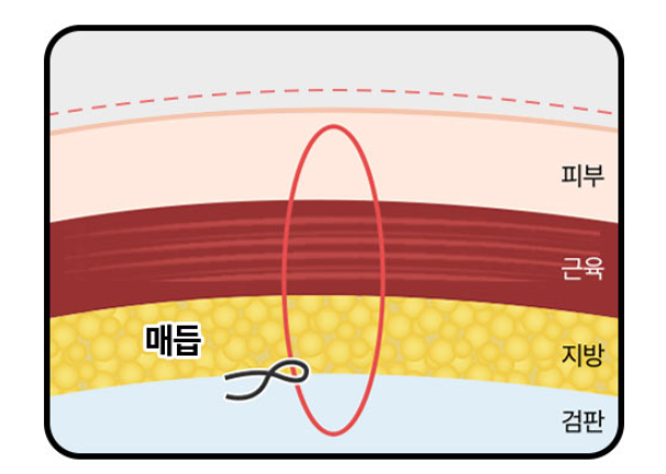 자연유착 쌍꺼풀, 재수술을 줄이려면 관련 이미지 3