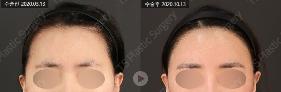 안면윤곽수술 후 헤어라인 교정과 모발이식이 필요한 이유는? 관련 이미지 3