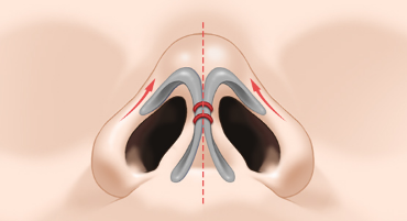 If hump nose surgery and alar reduction are performed together, it may help achieve harmonious facial proportions image 4