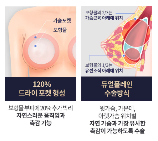 모티바가슴성형수술 알아봐야 할 정보 (촉감, 움직임과 모양) 관련 이미지 4