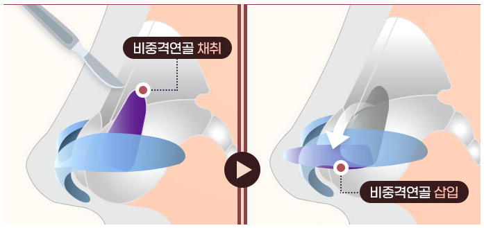 How Can a Deviated Septum After Rhinoplasty Be Corrected Without an Incision? image 2