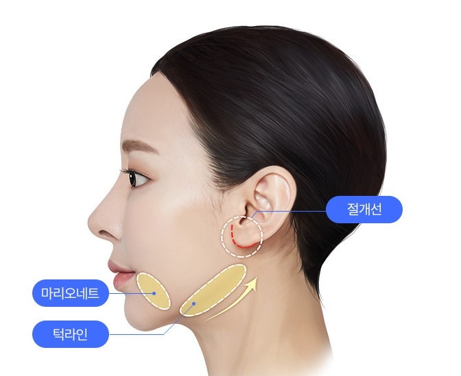 미니거상술 스마스층 고정이 중요한 이유 관련 이미지 1