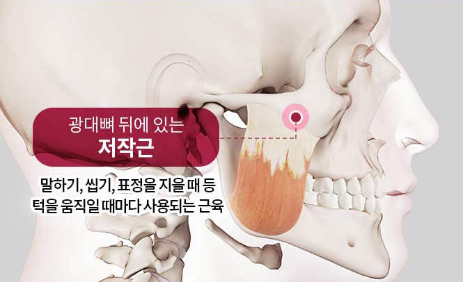 광대축소, 신중한 선택이 중요한 이유 관련 이미지 2