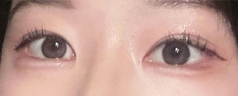 Revision Eyelid Surgery Case: Correcting an Eye Shape That Felt Heavy and Constricted Due to High, Thick Double Eyelids image 5