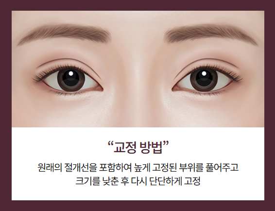 Revision Surgery for Sausage Eyes: How Is It Approached When There Is Not Enough Skin and Tissue? image 1