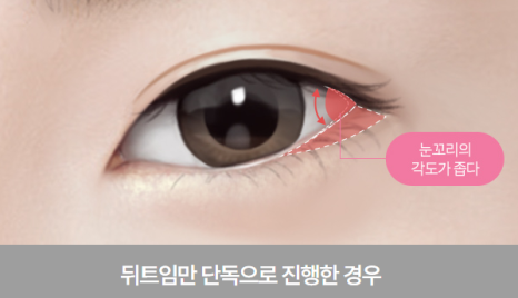 Dual Canthoplasty: Performing Outer and Lower Canthoplasty at the Same Time image 3