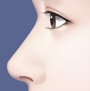 Male Nose Surgery: A Choice for Aesthetic Balance and Functional Improvement image 2