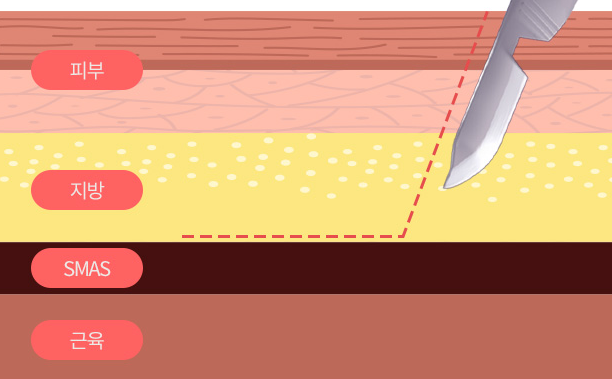 Mini Facelift Surgery: In What Cases Can It Be Considered? image 2