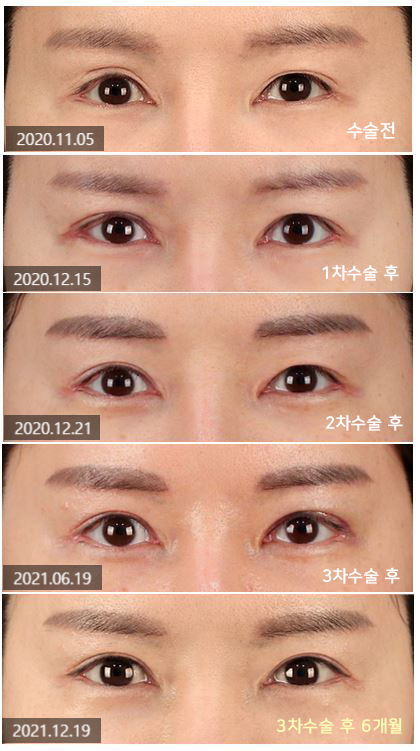 티에스 극한눈 재수술 리뷰(1) 피부부족, 비대칭, 토안증이 심했던 분의 수술전후 변화 관련 이미지 11