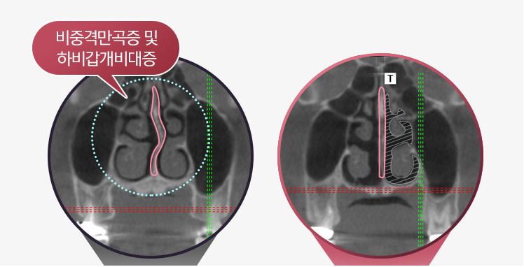 How Can a Deviated Septum After Rhinoplasty Be Corrected Without an Incision? image 4