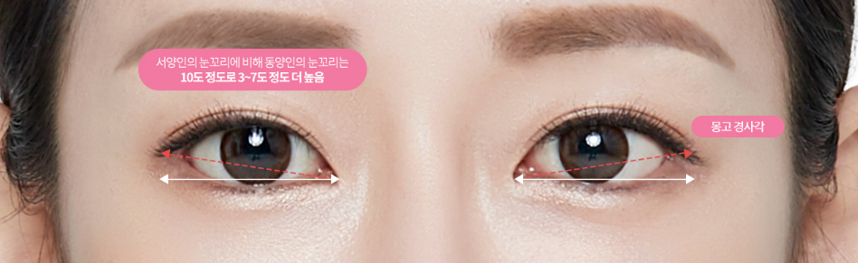 뒷트임, 밑트임, 눈트임 수술로 자연스러운 눈매 교정 관련 이미지 2