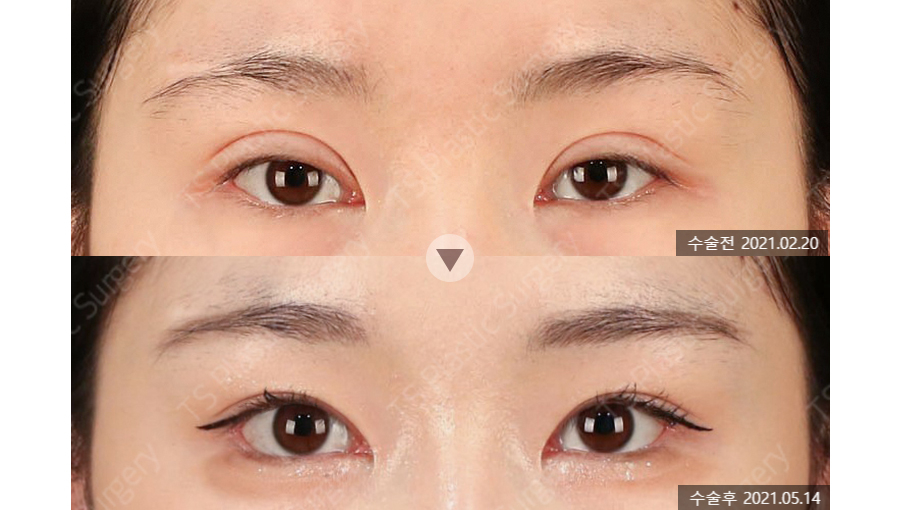 Revision Eyelid Surgery Case: Correcting an Eye Shape That Felt Heavy and Constricted Due to High, Thick Double Eyelids image 6