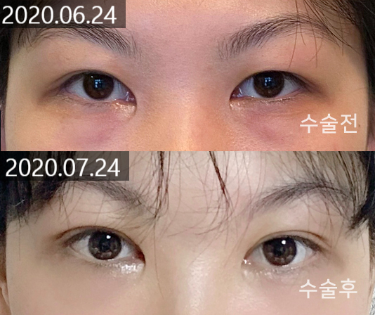 Changes and Causes That Can Occur When the Double Eyelid Line Becomes Weaker image 2