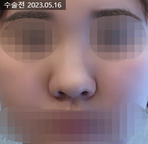 If hump nose surgery and alar reduction are performed together, it may help achieve harmonious facial proportions image 5
