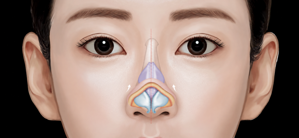 복코 코성형 지방 제거만으로 날렵해질 수 있을까? 코끝 연골 묶기와 박리의 진실 관련 이미지 3