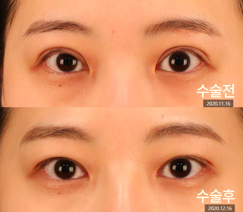 How Can You Avoid Needing Revision Surgery After Double Eyelid Surgery? image 5