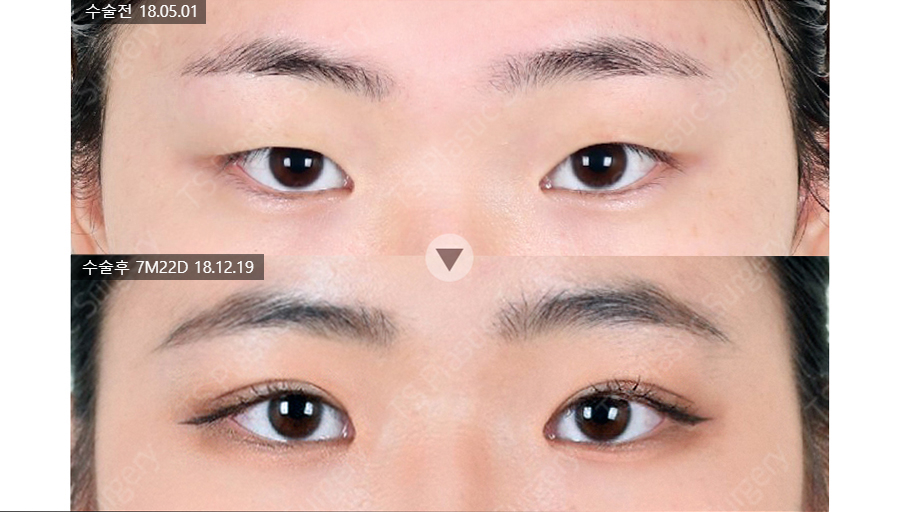 함몰눈은 어떻게 쌍꺼풀 수술을 해야 할까? 관련 이미지 3