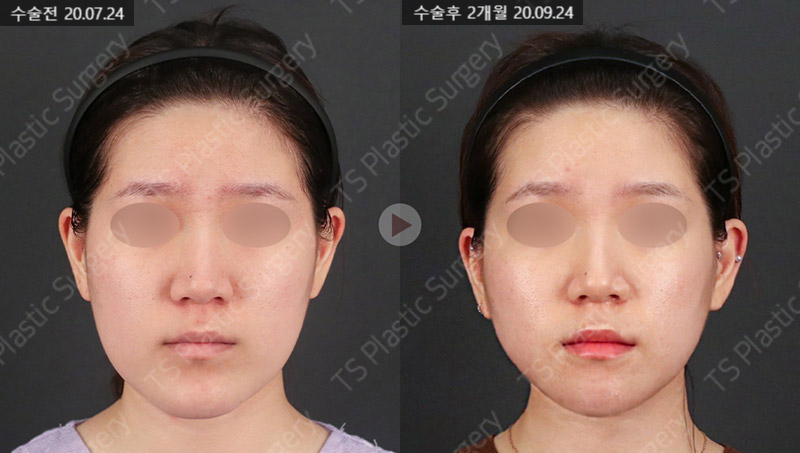 주걱턱, 양악수술 없이 턱끝수술로 개선할 수 있을까요? 관련 이미지 4