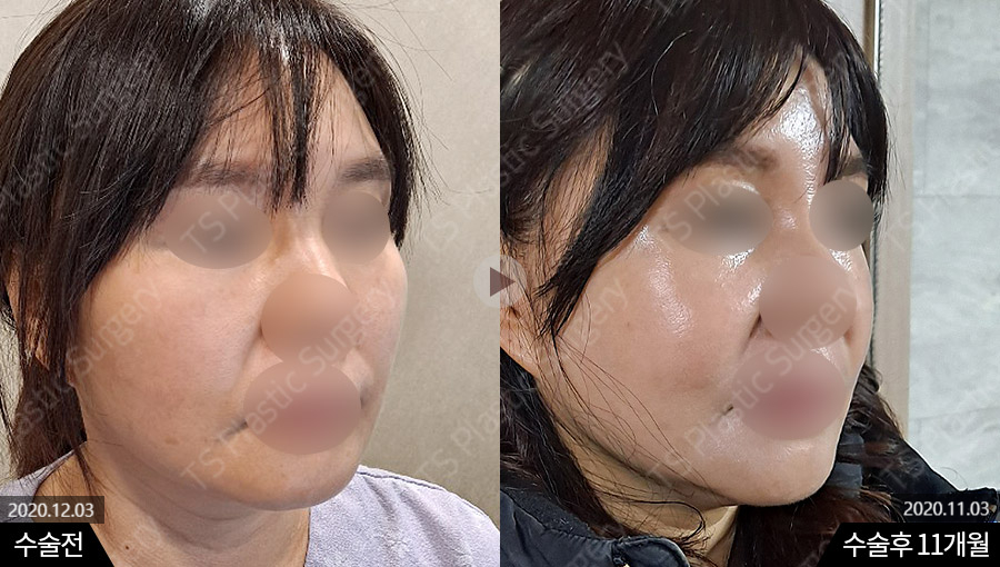 윤곽수술(광대축소수술, 사각턱수술) 후 볼처짐, 살처짐은 걱정해야 하는 부분일까? 관련 이미지 2