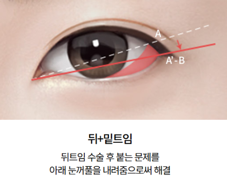 Dual Canthoplasty: Performing Outer and Lower Canthoplasty at the Same Time image 2