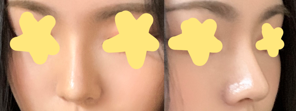 [코수술 리뷰] 낮고 코끝이 들린 짧은코성형 케이스 리뷰 관련 이미지 9