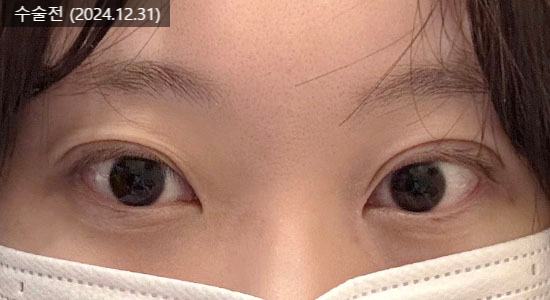 If You’re Worried About a Sausage-Like Double Eyelid, Check Whether the Hospital Is Good at Double-Line Method Revision Surgery image 2