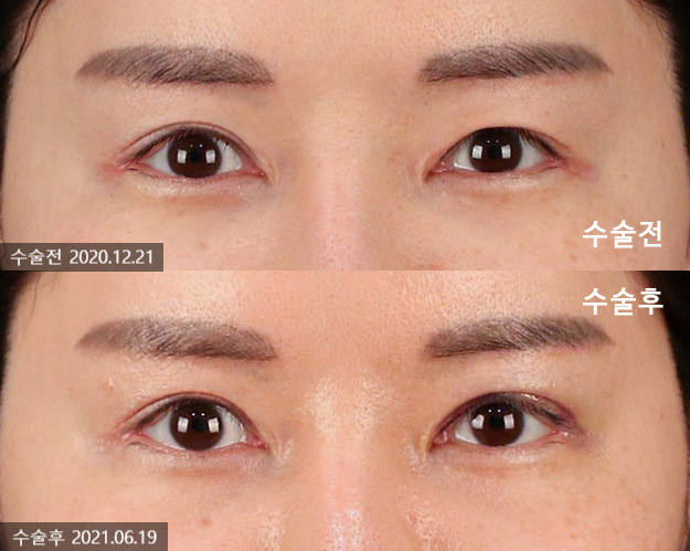 티에스 극한눈 재수술 리뷰(1) 피부부족, 비대칭, 토안증이 심했던 분의 수술전후 변화 관련 이미지 9