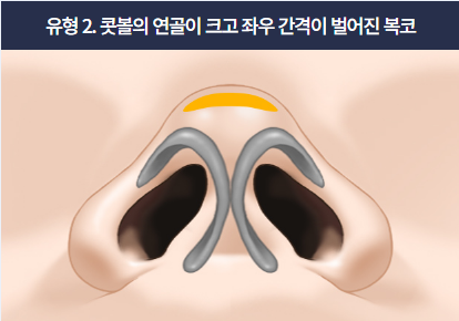 If hump nose surgery and alar reduction are performed together, it may help achieve harmonious facial proportions image 3
