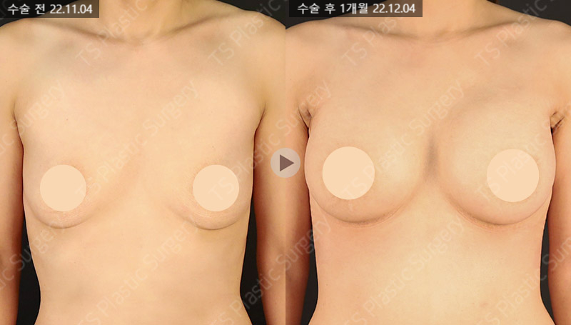 In Which Cases Can Sagging Breasts Be Improved with Implants Alone? image 3