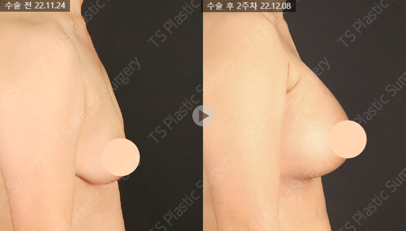 In Which Cases Can Sagging Breasts Be Improved with Implants Alone? image 4