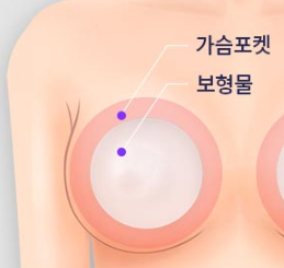 Breast Augmentation: Finding Natural Volume That Fits My Body image 1