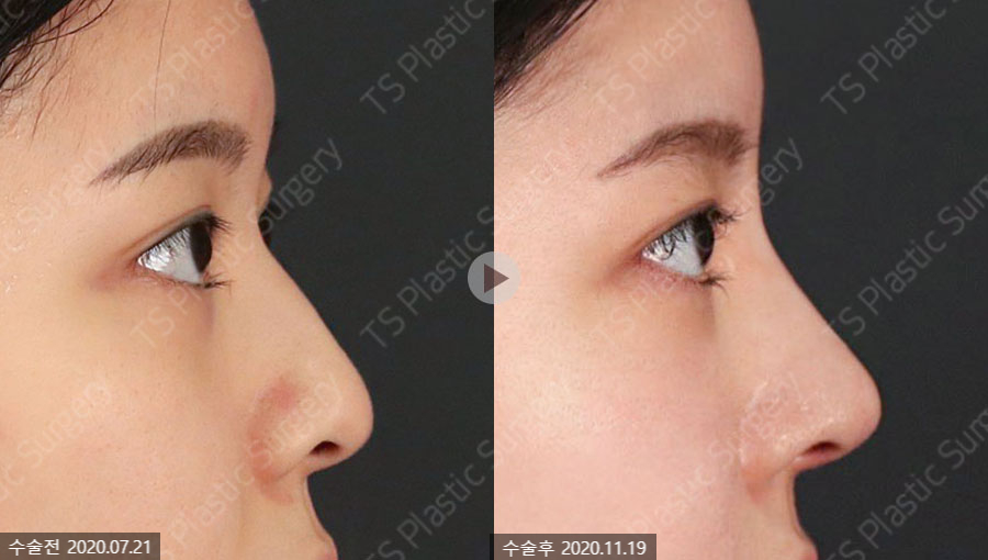 Rhinoplasty: Why Are Angle and Material Selection So Important? image 7