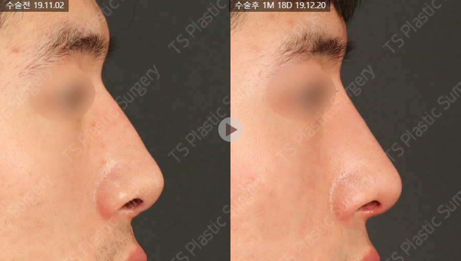 Natural Rhinoplasty That Refines the Nasal Tip with Ear Cartilage image 7