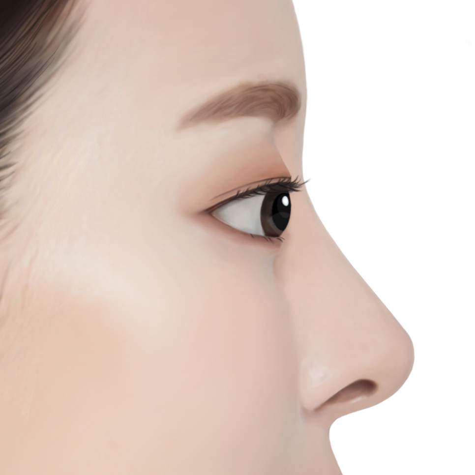 How Should Double Eyelid Surgery Be Performed for Protruding Eyes? image 1