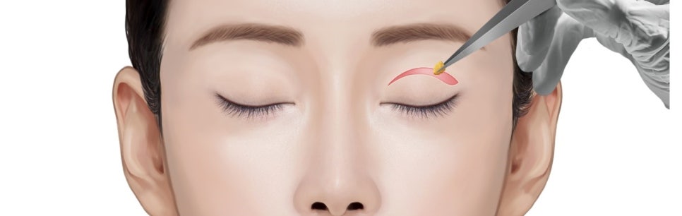눈두덩이 꺼짐 겹주름눈 지방이식이 아닌 눈위지방재배치로 충분할까? 관련 이미지 3
