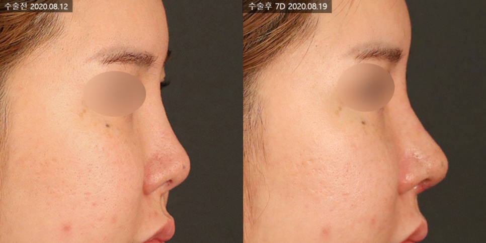 What Is Contracted Nose? Causes That Can Lead to Revision Rhinoplasty and Key Management Points image 3