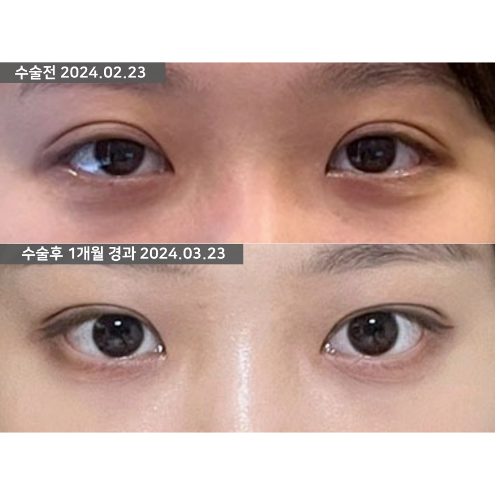 두꺼운 쌍꺼풀 라인을 낮출 때, 두줄따기 방법을 고려할 수 있는 이유 관련 이미지 2