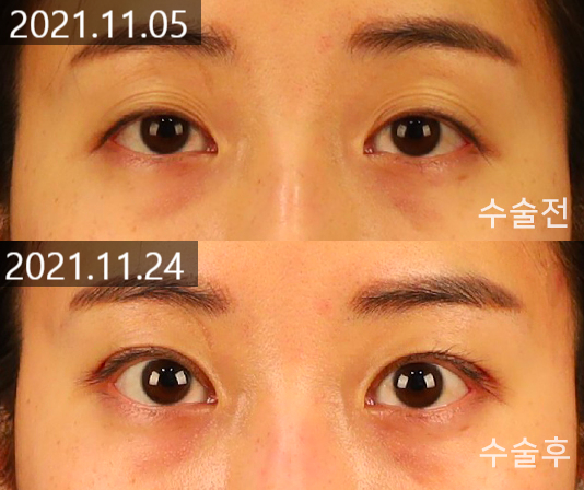 Changes and Causes That Can Occur When the Double Eyelid Line Becomes Weaker image 5