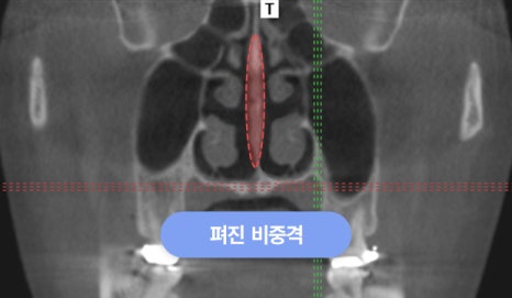 휜코 교정, 개인별 원인 분석이 중요한 이유 관련 이미지 8