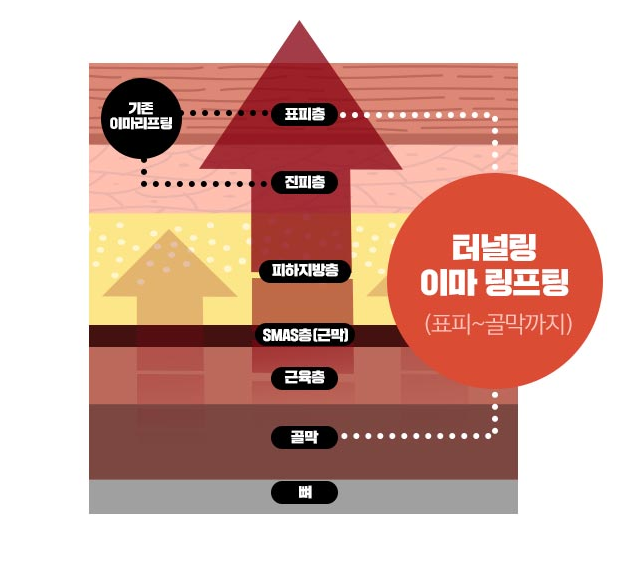 20~30대 이마리프팅 왜 필요할까? 관련 이미지 10