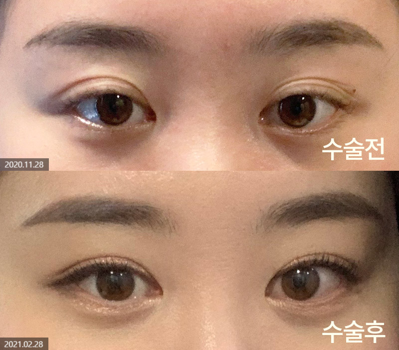 How Can You Avoid Needing Revision Surgery After Double Eyelid Surgery? image 6