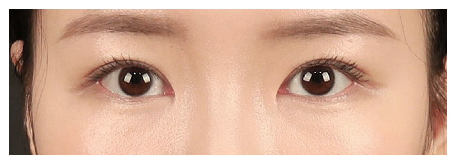 If the double eyelid line is set too thick, how should revision surgery be approached? image 4