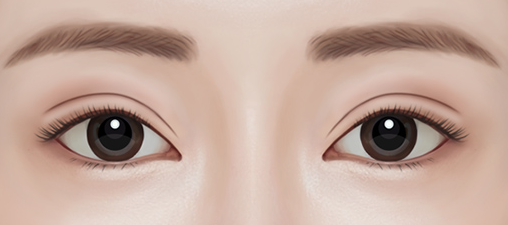 Important Points to Consider When Thinking About Revision Surgery After Eye Surgery image 4