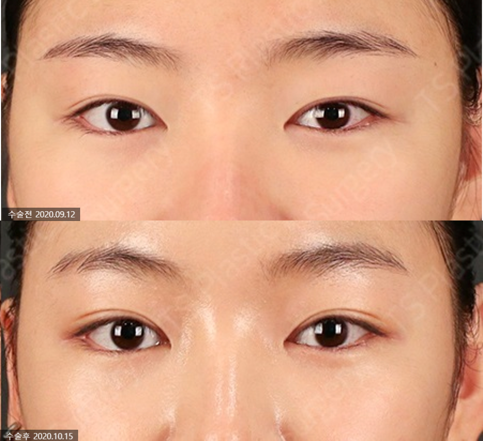 20~30대 이마리프팅 왜 필요할까? 관련 이미지 7