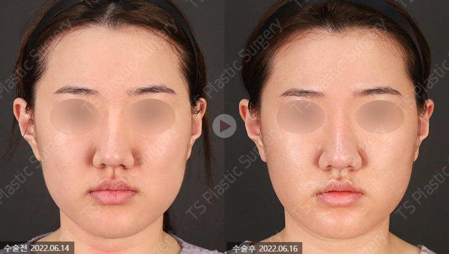 How Can a Deviated Septum After Rhinoplasty Be Corrected Without an Incision? image 1