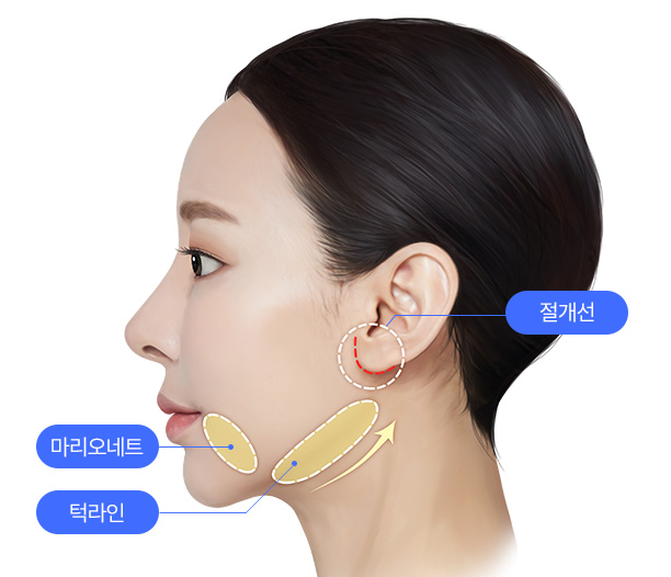 Mini Facelift Surgery: In What Cases Can It Be Considered? image 1