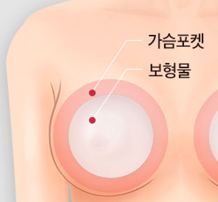 가슴 수술의 중요 포인트: 안전하고 신뢰할 수 있는 선택 관련 이미지 5