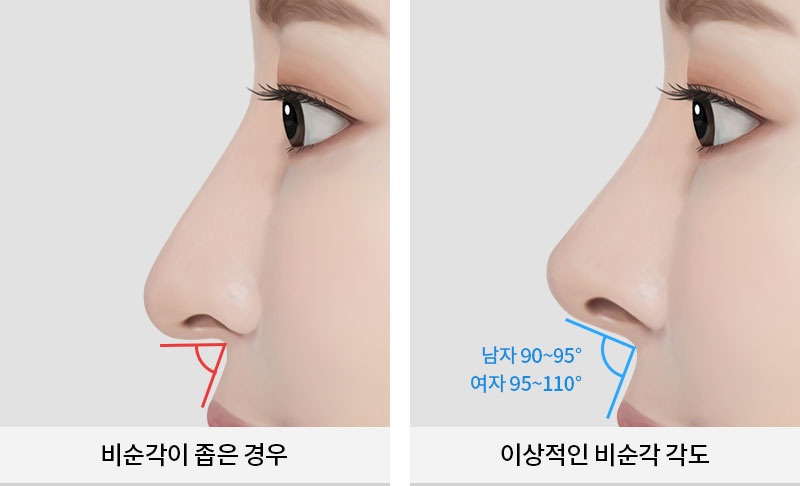 Rhinoplasty: Why Are Angle and Material Selection So Important? image 5