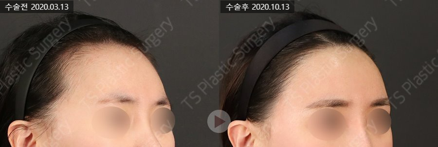 안면윤곽수술 후 헤어라인 교정과 모발이식이 필요한 이유는? 관련 이미지 4